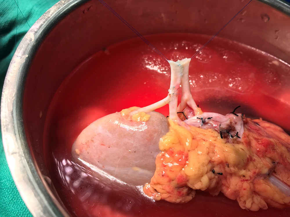 End-to-side anastomosis between upper pole artery and major trunk of the upper main renal artery and side-to-side anastomosis between the 2 dominant renal arteries.