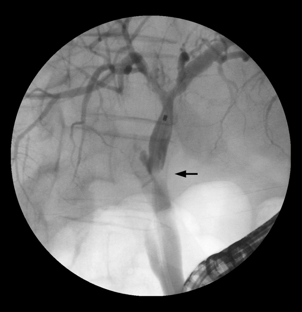 Anastomotic stricture (arrow) visualized via endoscopic retrograde cholangiopancreatography (ERCP).