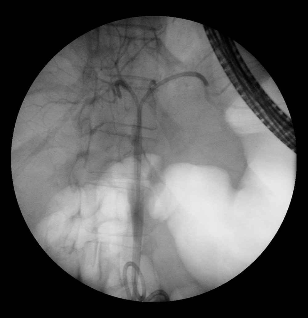 Same patient as in Figure 1. After dilatation and stent placement.