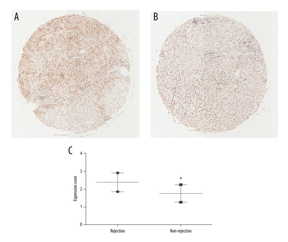 High-mobility group box 1 (HMGB1) expression in resected recipient livers. (A) Typical immunohistochemical (IHC) staining results were obtained from the rejection group. (B) Typical IHC staining results were obtained from the non-rejection group. (C) HMGB1 expression levels in the 2 groups. The data are expressed as means±standard deviations. * P<0.05 vs the rejection group.