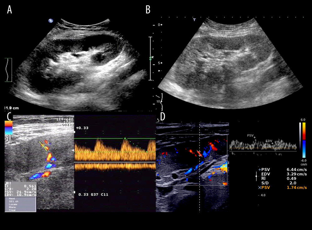Ultrasonic characteristics of recurrent IgAN: ultrasound showed equal echo of the renal parenchyma in mild injury (Lee’s II) (A) by contrast with echo enhancement in severe injury (Lee’s IV) (B); hemodynamics showed markedly decreasing EDV of the SRA in severe injury (Lee’s IV) (D) proceeded from mild injury (Lee’s II) (C) (Photoshop, 21.1, Adobe).