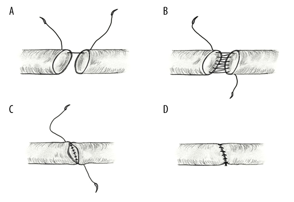 (A–D) Illustration of parachute technique used in hepatic artery reconstruction using a loupe. (Adobe Sketch, V 4.7, Sketch B.V.)