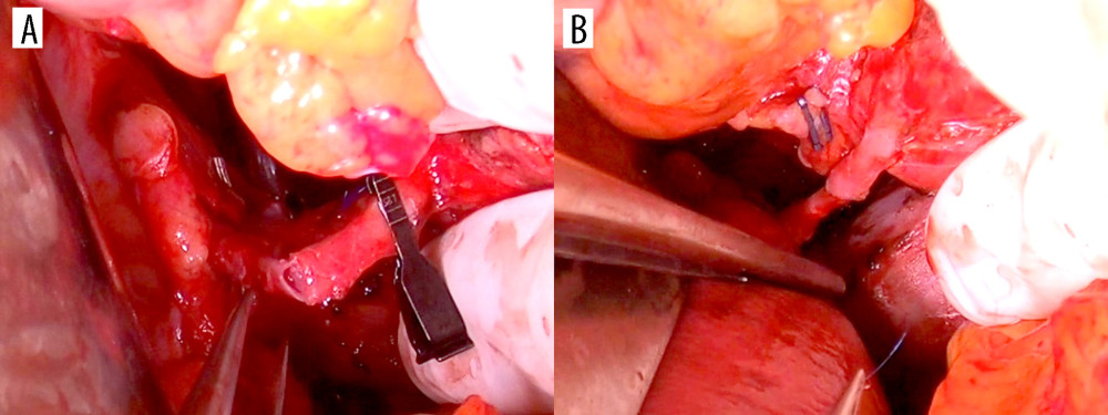 Photograph of hepatic artery reconstruction with parachute technique. (A) After posterior wall suture. (B) Completion of continuous suture.