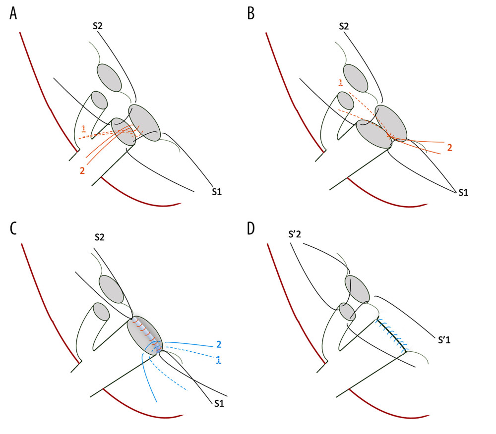 Steps of the dual biliary duct reconstruction, demonstrated as the anastomosis of the right posterior intrahepatic duct (IHD) to the common hepatic duct (CHD)/anastomosis of the right anterior IHD to the cystic duct: (A) S1 and S2 represent 6-0 interrupted sutures through ductal edges on both sides, serving as long stay sutures. Reconstruction is initiated at the posterior wall of the bile duct at the medial side, as shown by the orange lines. (B) The second stitch (orange line 2) is moved in the opposite direction to create a working space and then the knot is secured in the first stitch (orange line 1). Proceed laterally and posteriorly stitch by stitch until the posterior part is completed. Care should be taken to ensure to tie the knots outside the bile duct lumen. (C) After the posterior wall is completed, start the anterior wall from the superior or medial side, and finish by tying knots, which are sutured into the edges of ducts but remain untied until the end for a clearer view. (D) Start the right anterior IHD-cystic duct anastomosis using stay long sutures (S1 and S2) and follow the aforementioned steps.