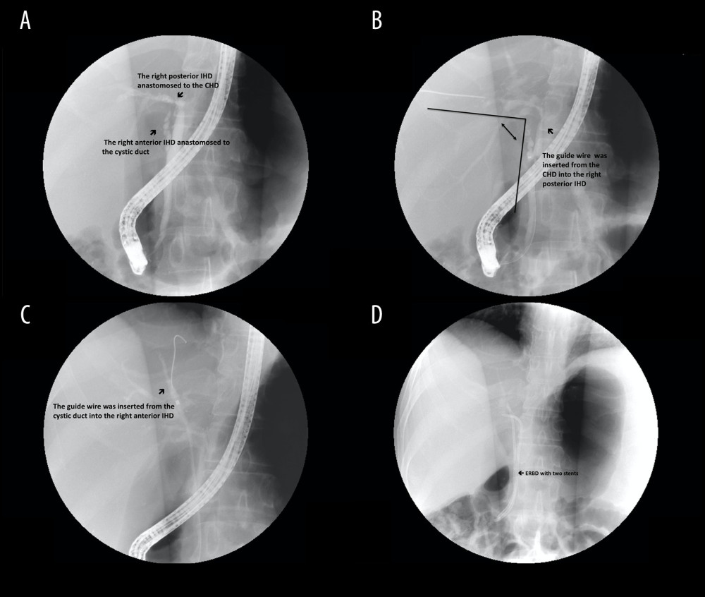 Steps of type B reconstruction: (A) right posterior intrahepatic duct (IHD) anastomosed to the common hepatic duct (CHD), and right anterior IHD anastomosed to cystic duct; (B) guide wire is inserted through the CHD into the right posterior IHD, showing the sharp angle of biliary axis between the IHD of the graft and the native CBD of the recipient; (C) guide wire is inserted through the cystic duct into the right anterior IHD; (D) endoscopic retrograde biliary drainage with 2 stents in the strictures of dual anastomosis.