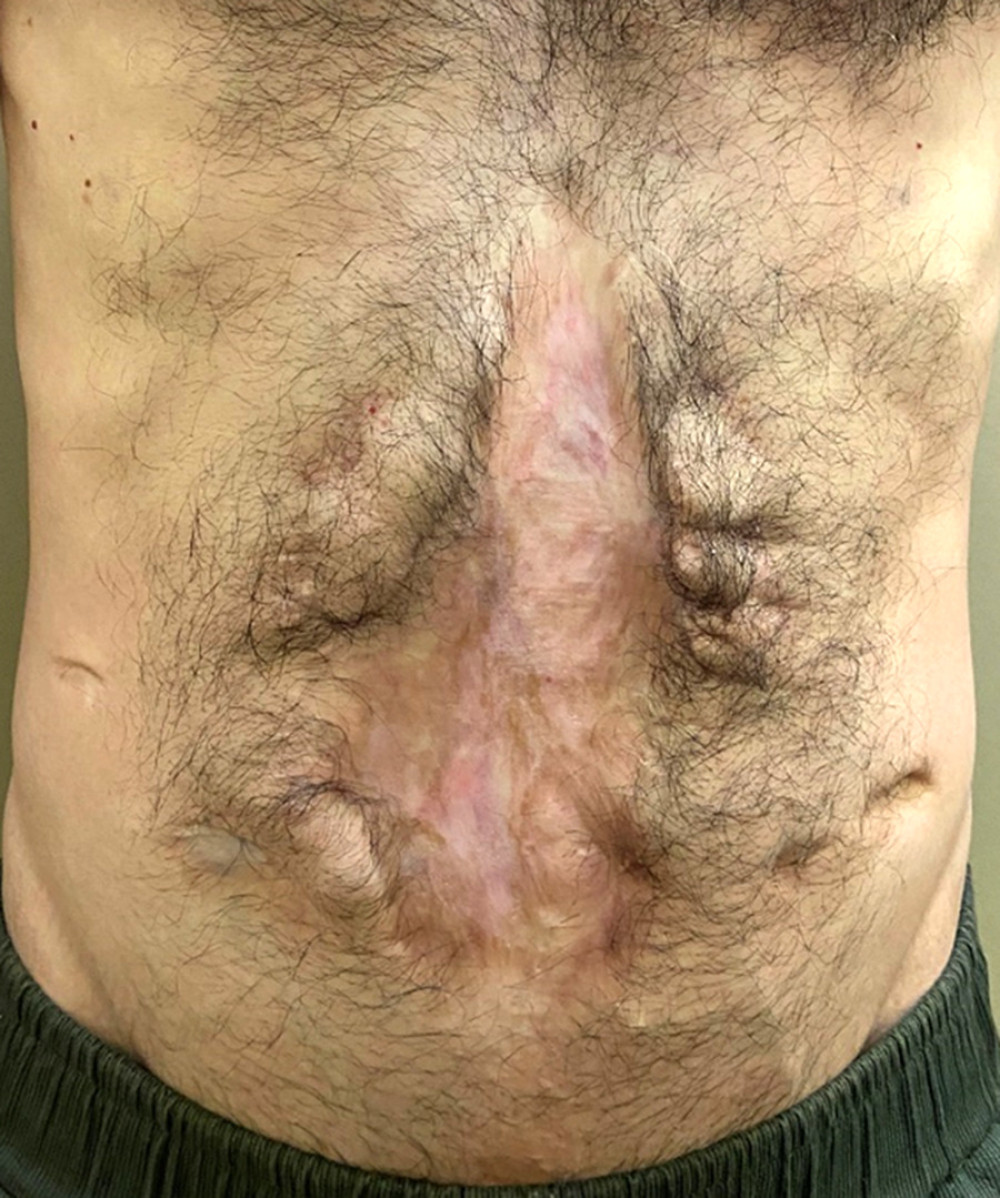 Extensive abdominal fibrosis resulting from second intention healing of peritoneostomy and ostomy scars. (Arsenal of the department.)
