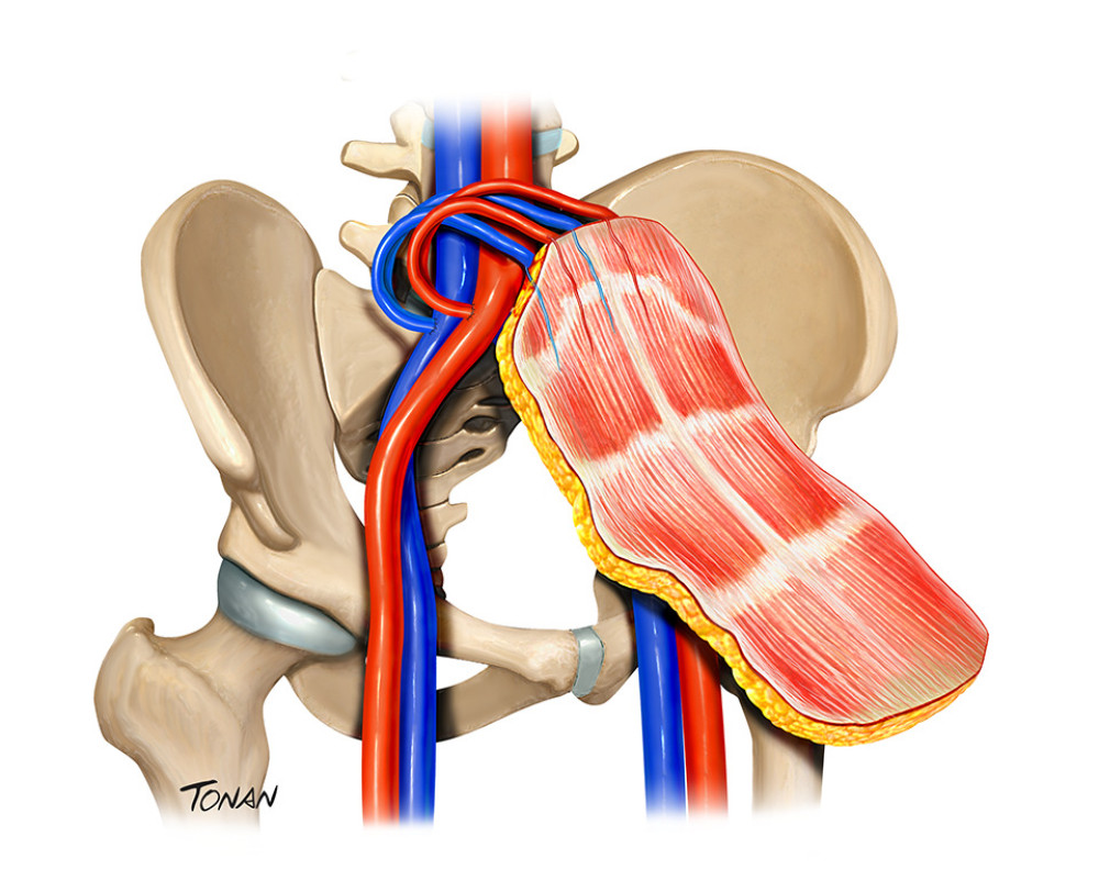 Abdominal wall transplantation. Created with Adobe® Photoshop.