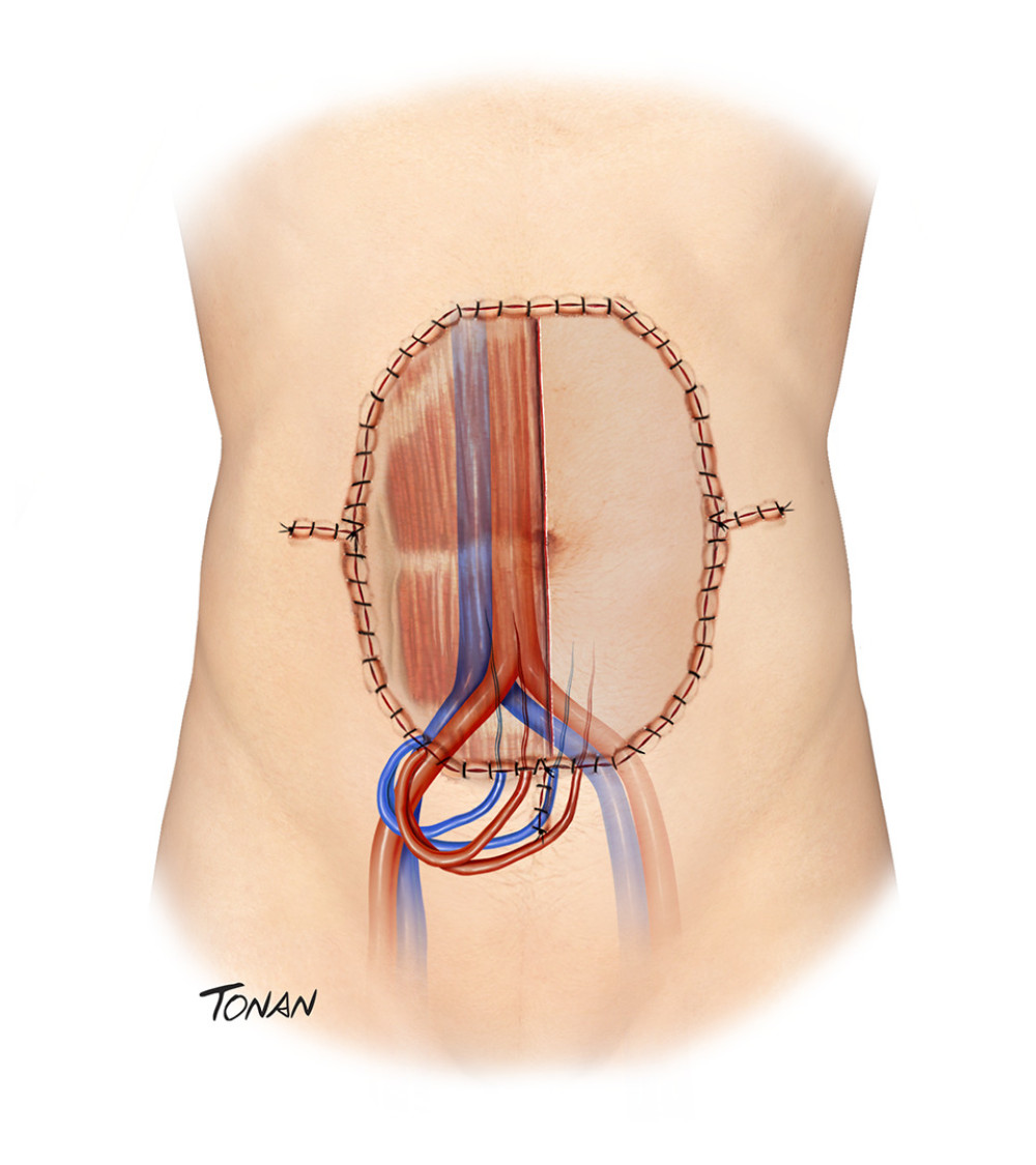Abdominal wall transplantation. Created with Adobe® Photoshop.
