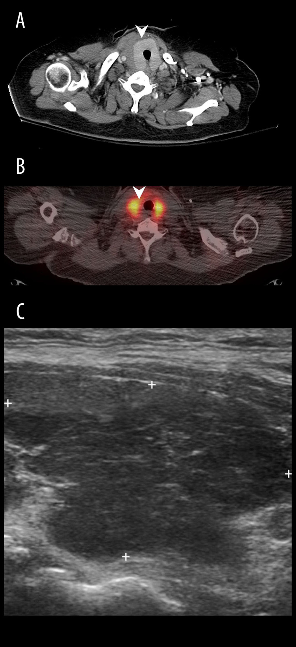 A 60-year-old woman with hepatitis C-related liver cirrhosis. (A) Chest CT showed an enlarged thyroid gland without mass; (B) 18F-FDG PET/CT revealed diffuse uptake over bilateral thyroid with SUVmax up to 12.8; (C) Longitudinal view of thyroid echo disclosed hypoechoic parenchyma, compatible with thyroiditis change.