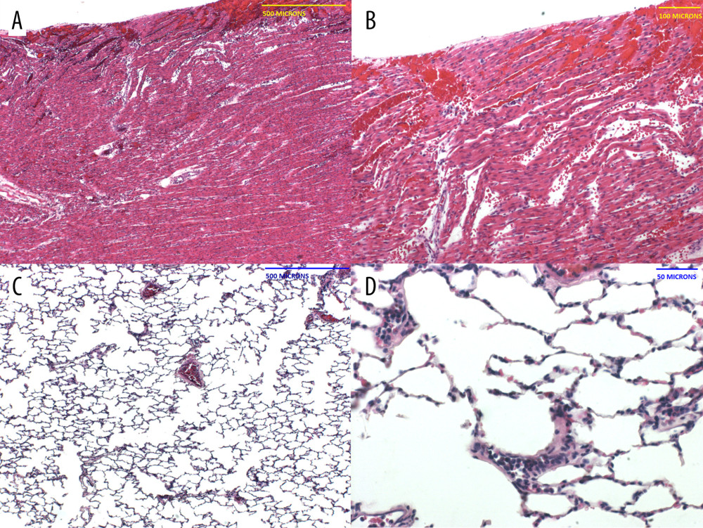 Histopathology of the pig heart (A, B) and baboon lungs (C, D) in B217 at necropsy(A, B) The heart showed multifocal foci of hemorrhage and myocardial necrosis, particularly within the left ventricle, suggestive of ischemia-reperfusion injury. (C, D) The lungs exhibited minimal lesions in airways and alveoli, but showed clusters of neutrophils in small vessels, and pulmonary edema (not shown).