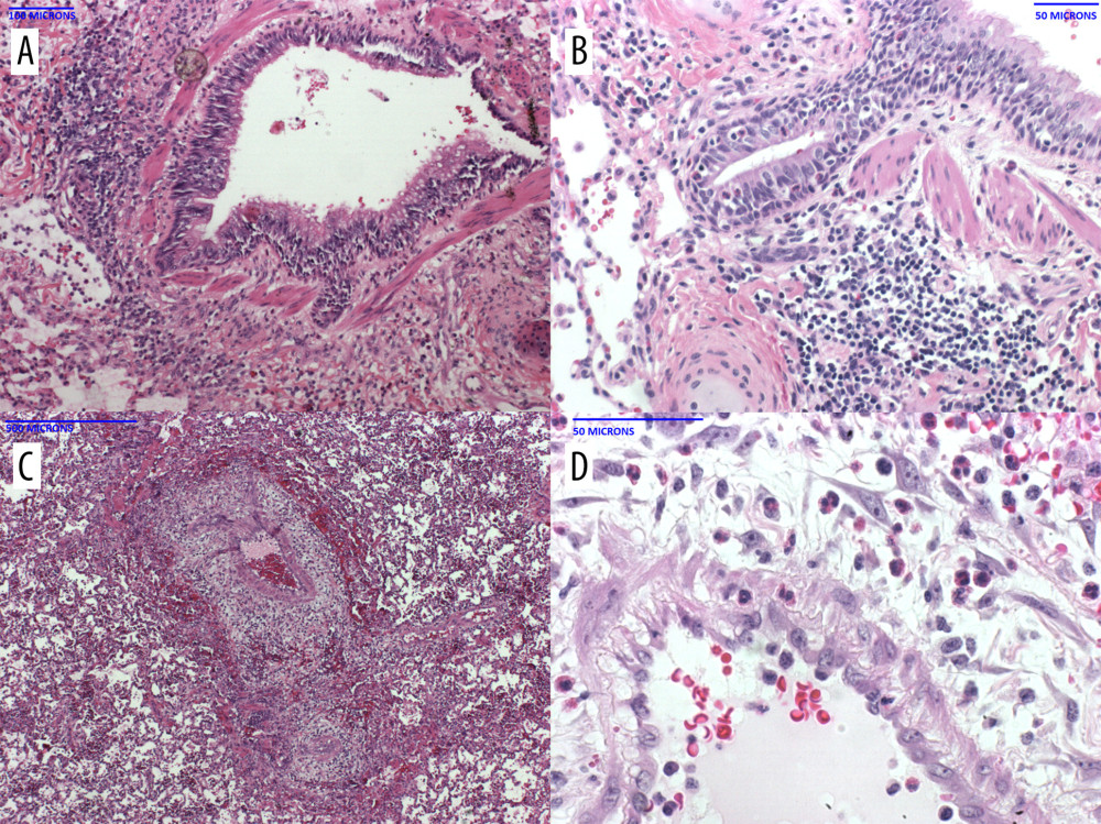 Histopathology of the baboon lungs (A–D) in B37367 at necropsyThe lungs showed diffuse prominent airway inflammation (A) that included the airway epithelium (B). The infiltrate contained a high number of eosinophils. The arteries were also inflamed, as was the perivascular tissue (C). Eosinophils were seen in the perivascular tissue and vascular media (D).