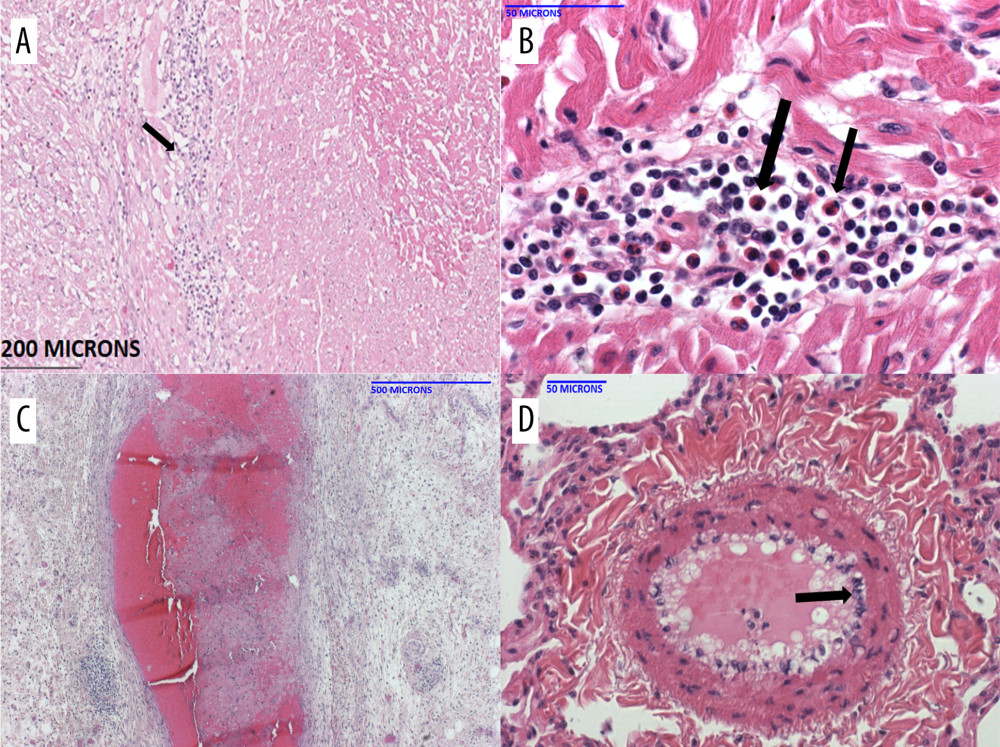 Histopathology of the pig heart (A–D) in B15416 at necropsy(A) The heart showed mild inflammation and fibrosis within the myocardial interstitium, and around the Purkinje fibers. Higher magnification showed a fair number of eosinophils in the infiltrate (B). The coronary arteries (C) exhibited significant mature fibrin thrombi, resulting in narrow intravascular lumens. Within the lungs (and heart, not shown), there were multiple medium-caliber arteries with endothelial activation (D, arrow).