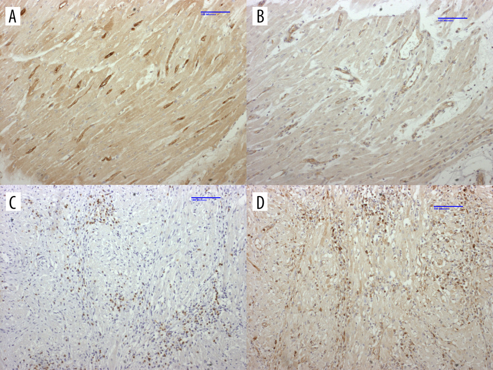 Immunohistochemistry of heart in B1917 was consistent with acute antibody-mediated and chronic cell-mediated rejectionLeft ventricle with significant IgM (A) and C4d (B) staining of interstitial capillary endothelium is consistent with antibody-mediated rejection. Interventricular septum displays significant numbers of CD3+ T cells (C) and IgM+ B cells (D) that is consistent with cell-mediated rejection