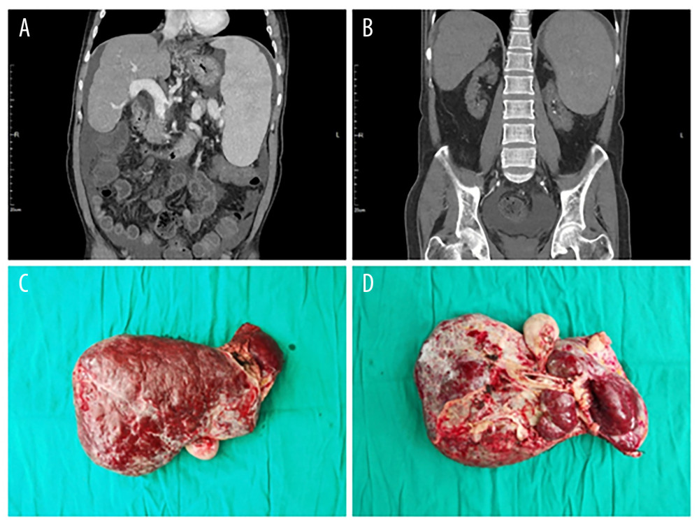(A, B) Preoperative CT examination shows severe liver cirrhosis, splenomegaly, and atrophy of both kidneys. (C, D) Intraoperative resection of the diseased liver.