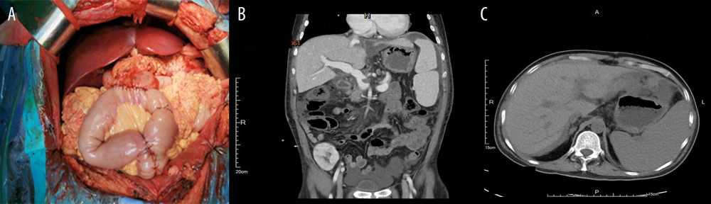 (A) Intraoperative anastomosis. (B, C) Postoperative CT scan.