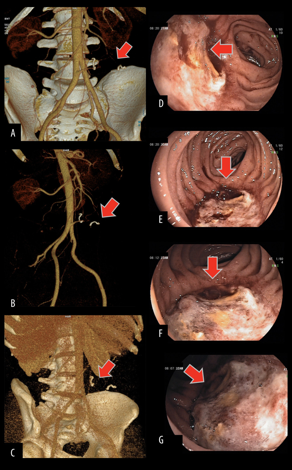 (A–C) 3D vascular reconstructions of Computed Tomography. A, B – Arterial phase. C – Venous phase. The marks show the localization of pancreatic graft. It is not visible because of the absence of blood flow. (D–G) Images from gastroduodenoscopy. Marks show the necrosis of the mucosa of transplanted duodenum with central ulceration.