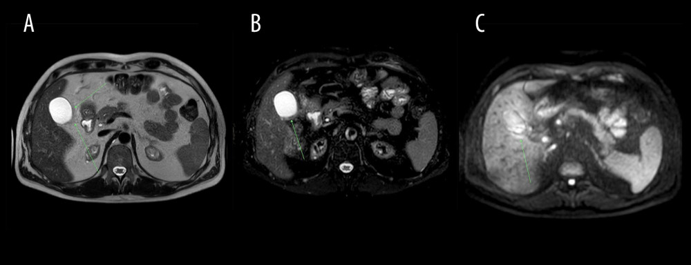 Abdominal CT axial images at the gallbladder level (arrows). (A) Non-contrast CT (performed on Nov 25, 2020) presented normal gallbladder, (B) Contrast enhanced CT on Dec 2, 2020 indicated slightly enhanced and thickened gallbladder wall, pericholecystic fluid, and inflammatory fat stranding (arrow), (C) Non-contrast CT revealed partial resolution of inflammatory process on Dec 9, 2020.