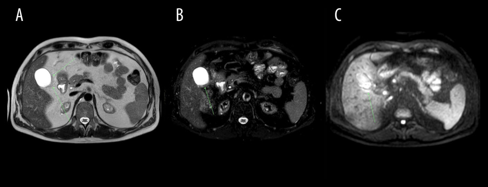 Abdominal MRI obtained on December 10, 2020. (A) T2-weighted, (B) T2 SPAIR, (C) DWI; axial images at the gallbladder level. Gallbladder surrounded by inflamed adipose tissue (arrow) – low signal intensity on T2-weighted and T2 SPAIR images and increased signal intensity on diffusion-weighted image.