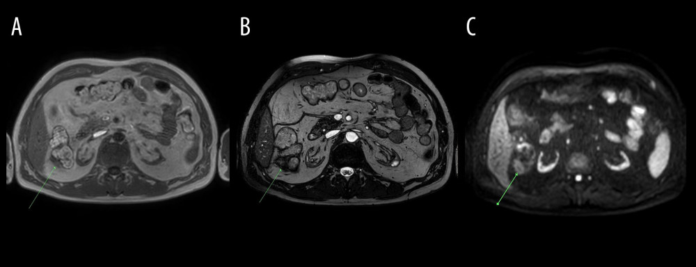 Abdominal MRI obtained on December 10, 2020. (A) mDIXON (water), (B) BTFE, (C) DWI axial images at the level of the right colic flexure. Epiploic appendagitis and inflamed attached adipose tissue (arrows): low signal intensity on T1-weighted (mDIXON water) as well as on BTFE images and increased signal intensity on DWI image.