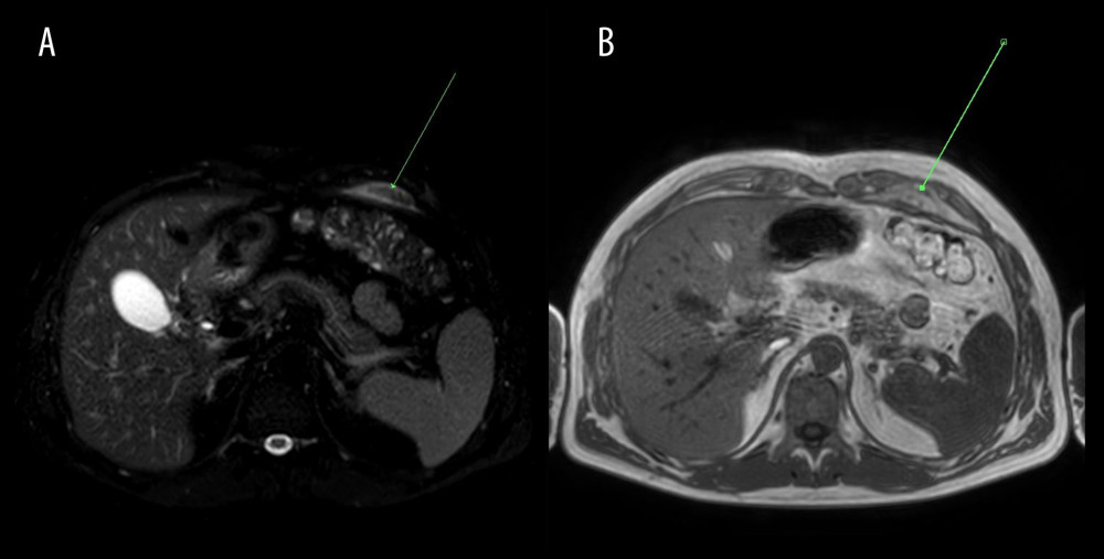 Abdominal MRI obtained on December 10, 2020. (A) T2 SPAIR, (B) mDixon water, (C) DWI axial images at the level of pericardial fat. Inflammation of pericardial fat pad in the left cardiophrenic angle – increased signal intensity on T2 SPAIR as well as on DWI images and decreased signal intensity on T1-weighted (mDIXON water) image.