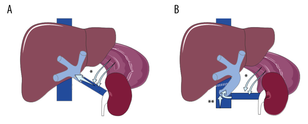 Hemitransposition anastomosis. (A) Renoportal anastomosis; (B). Cavoportal anastomosis. * Splenoral spontaneous or surgical shunt. ** Staplle line on the IVC downstream to the cavoportal anastomosis.