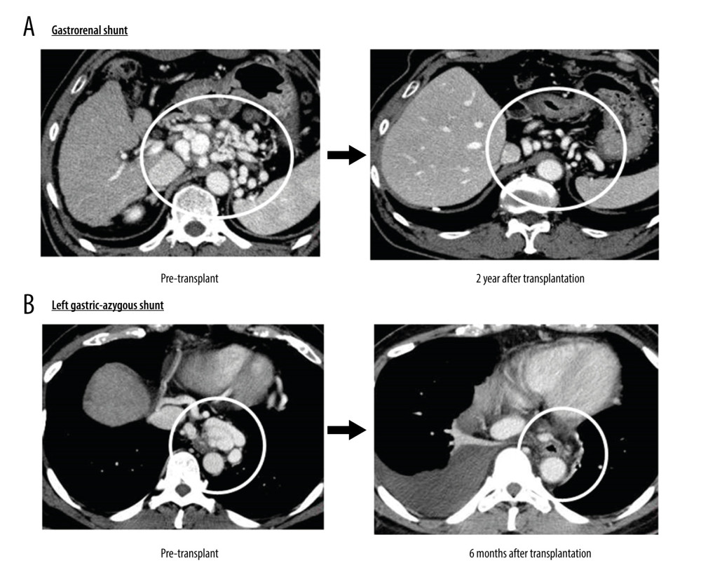 Regression of spontaneous portosystemic shunts (SPSS)(A) Gastrorenal shunt: The gastrorenal shunt had shrunk remarkably at 2 years after liver transplantation (LT). (B) Left gastric-azygous shunt: The left gastric shunt was too thin to detect 6 months after LT.