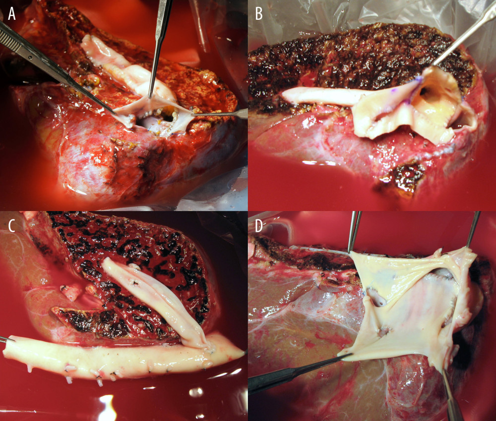 Configurations of all-in-one sleeve venoplasty. (A) A right liver graft (RLG) has 1 right hepatic vein (RHV) opening, 1 adjacent inferior right hepatic vein (IRHV) opening, 1 segment V vein (V5) opening, and 1 segment VIII vein (V8) opening. The RHV and IRHV openings were directly unified. An iliac vein conduit was attached to the V5. V8 was located close to the RHV opening, so they were unified. A semicircular fence with the autologous greater saphenous vein patch was attached (type 1). (B) An RLG has 1 RHV opening, 1 distant IRHV opening, 1 V5 opening, and 1 V8 opening. An iliac artery conduit was attached to the V5 and V8, and then unified with the RHV opening. Arterial patches were attached to the IRHV (type 1). (C) An RLG has 1 RHV opening, 1 distant IRHV opening, 1 V5 opening, and 1 V8 opening. An abdominal aorta was attached to the RHV and IRHV. An iliac vein conduit was attached to the V5 and V8, and then connected to the aorta graft (type 1). (D) An RLG has 1 RHV opening, 2 distant IRHV openings, and 1 V8 opening. They were unified with a large-sized common iliac vein patch (type 2).