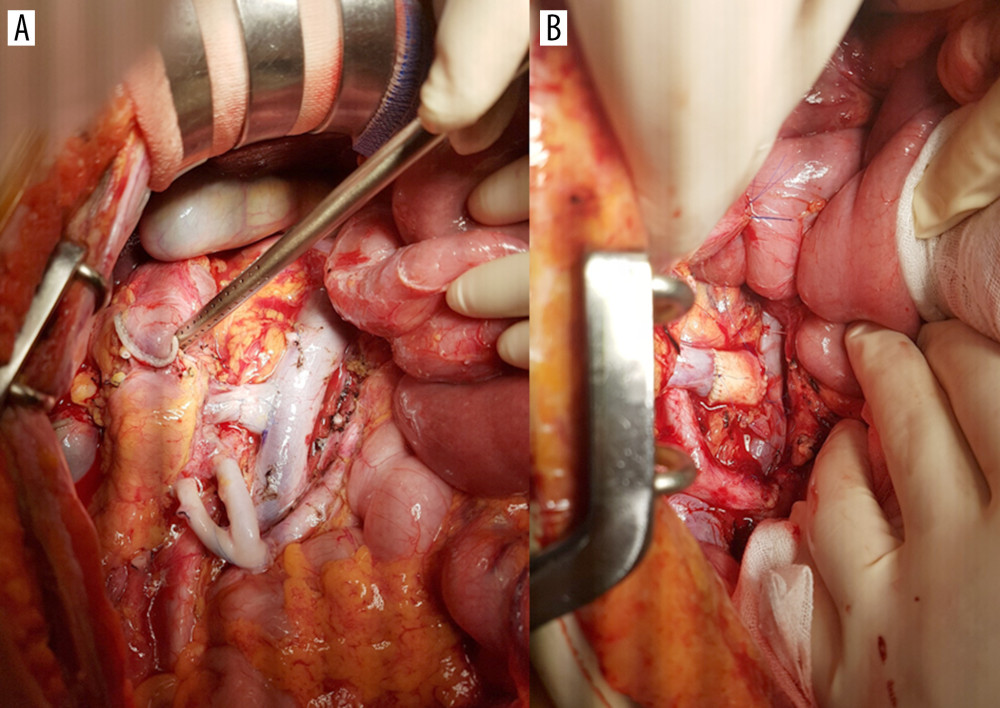 End-to-side anastomosis of the fence-angioplasty (A) and the aortic interposition graft (B) to the recipient’s vena cava.