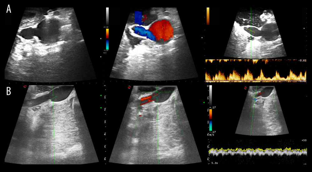 Intraoperative ultrasound findings. Anastomosis site structure, color Doppler and spectral wave of flow were evaluated in both groups (A, the vena cava group; B, the aorta group).