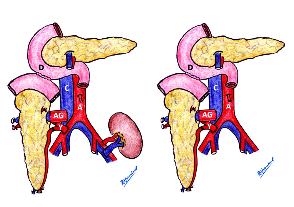 The aortic interposition graft schematic. Aortic interposition graft and duodenal exocrine drainage have been used to create a modified venous outlet. In the case of SPK or PAK, the transplanted kidney was implanted on the patient’s left side (left picture). The PTA case is shown on the right. Rune Horneland, a Norwegian transplant surgeon, created this illustration for this article. A – aorta; C – vena cava; D – duodenum, AG – aortic graft; Y – Y-graft.