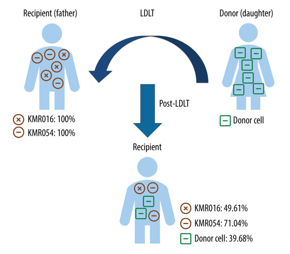 Chimerism assay results for pre- and post-transplantation samples using informative markers of recipient in Case 1 (KMR016 and KMR054). Figure created using PowerPoint 2016 (Microsoft Inc., Redmond, WA, USA). LDLT – living donor liver transplantation.