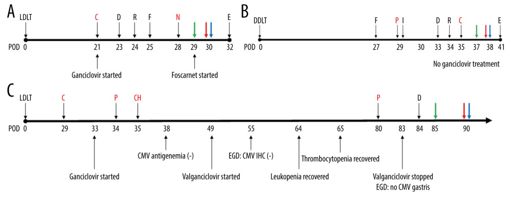 Timeline of recipients’ medical history and clinical courses (post-operative date unscaled); (A) Case 1, (B) Case 2, and (C) Case 3. Green arrow – skin or sigmoidoscopic biopsy; Red arrow – initiation of graft-versus-host disease treatment; Blue arrow – chimerism assay. Cytopenia and CMV related events are in red font. Figure created using PowerPoint 2016 (Microsoft Inc., Redmond, WA, USA). CMV – cytomegalovirus; POD – post-operative date; LDLT – living donor liver transplantation; DDLT – deceased donor liver transplantation; C – CMV antigenemia or qPCR (+); D – diarrhea; R – rash; F – fever; N – neutropenia; E – died; P – pancytopenia; I – Influenza positivity; IHC – immunohistochemistry; CH – CMV IHC (+); EGD – esophagogastroduodenoscopy; qPCR – real-time quantitative polymerase chain reaction.