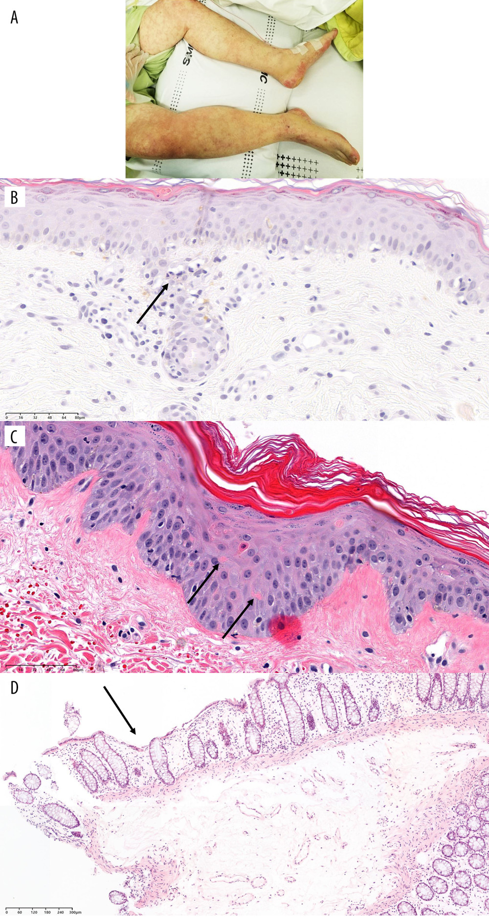 Physical and pathological findings of patients suspected to have graft-versus-host diseases and confirmation of donor chimerism. (A) Skin rash of case 1. (B) Trunk tissue biopsy findings of case 1 showing vacuolization (arrow) and basal cell degeneration. (C) Trunk tissue biopsy findings of case 2 showing an eosinophilic body at the lower layer of the epidermis (arrows). (D) Colonoscopic biopsy findings of case 3 exhibiting ulcer (arrow) and decreased number of crypts with size variation. B–D: hematoxylin and eosin staining. Scale bar is located in the lower-left corner.