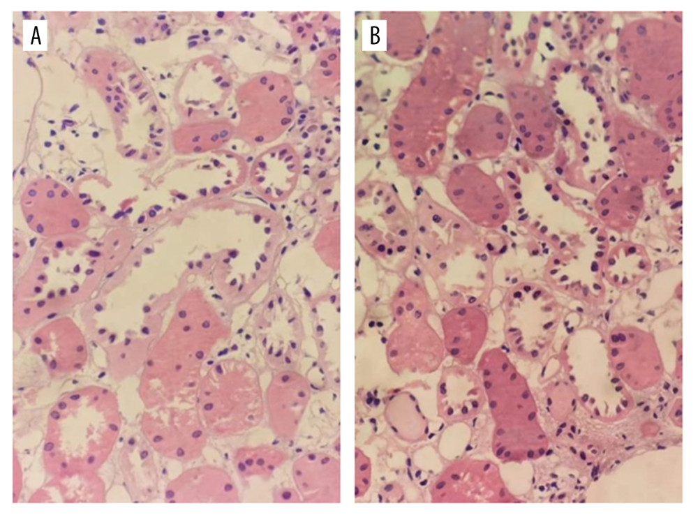 Pathological examination of donor kidney zero-point puncture biopsy. Figures A and B show the tubular type of epithelial cells in renal tubules. Some epithelial cells in renal tubules show edema with microvilli shedding (hematoxylin-eosin staining, 40×).