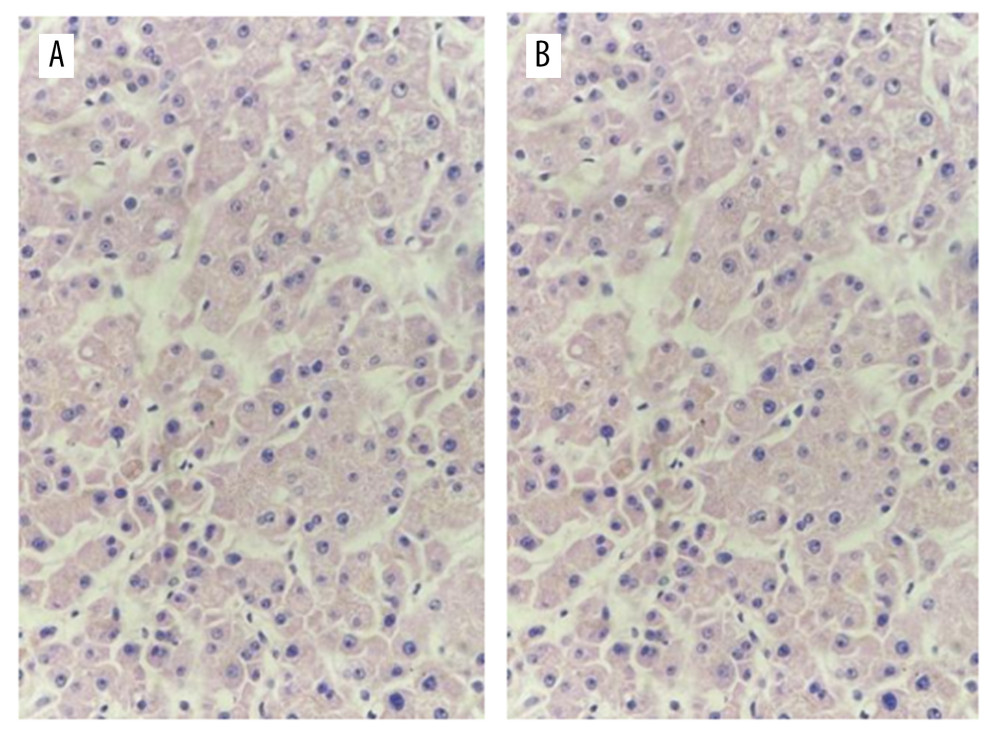 Liver zero-point puncture for pathological examination. Figures A and B show hepatocytes with slight edema, slight gallbladder silt, small infiltration of inflammatory cells, and occasionally punctate necrosis (hematoxylin-eosin staining, 40×).