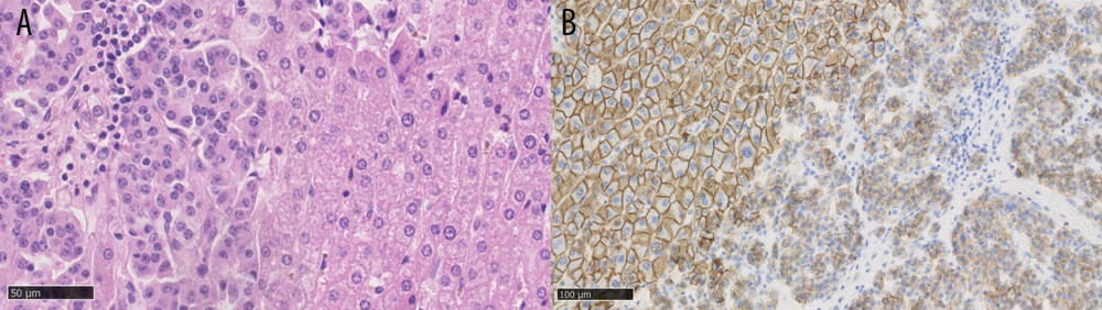 (A) Neuroendocrine liver metastases, hematoxylin and eosin staining, showing a well-differentiated tumor on the left side. (B) Neuroendocrine liver metastases, E-cadherin staining, showing loss of E-cadherin expression in tumor cells on the right side. Created using NDP.view2 (U12388-01), version 2.9.29, Hamamatsu Photonics.