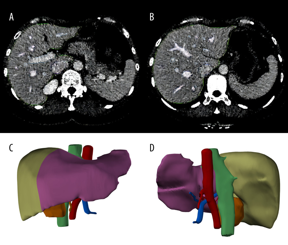 Liver segmentation using Mimics software program. (A, B), the liver was recognized in CT images. The green lines surround the scope of liver reconstruction. The purple and blue lines surround the hepatic veins and portal veins and their intrahepatic branches, respectively. (C, D), a whole liver was separated into left lobe (purple) and right lobe (light green), and the portal veins (blue), hepatic arteries (red) and biliary ducts (green) were reconstructed. (Created with Mimics 19.0 software)
