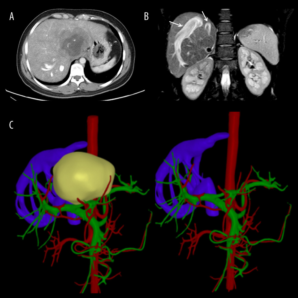 Representative perioperative images(A) Abdominal CT showed an AE lesion and mild hepatic congestion in the right lobe of the liver. (B) Abdominal MRI demonstrated dilation of RHV and SHV (arrow). (C) A three-dimensional model of liver was established before surgery, RHIVC was completely invaded and the RHV and SHV expanded and thickened to form multiple collateral circulation. Figures 1A and 1B were created using Adobe Photoshop 2022 V23.5. Figure 1C was created using 3D Studio Max 2020 from Autodesk.