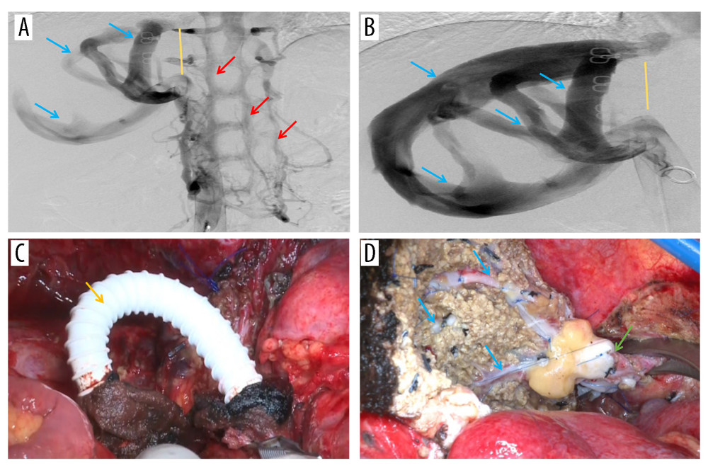 Representative perioperative and intraoperative images(A, B) IVC angiography showed invaded IVC (yellow line), dilated RHV and SHV (blue arrow), and formed vertebral venous plexus (red arrow). (C) The IVC was not reconstructed and temporary portacaval shunt was performed (yellow arrow). (D) Dilated collateral veins (blue arrow) were seen on the wound of the right lobe of liver and the suprahepatic vena cava anastomosed with the RHV (green arrow). Figures 2A–2D were created using Adobe Photoshop 2022 V23.5.