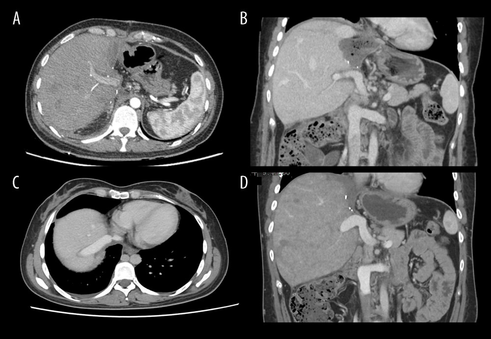 Abdominal CT before and 6 months after discharge(A, B) Abdominal CT before discharge showed that all vessels were unobstructed. (C, D) Follow-up abdominal CT 6 months after discharge showed no liver abnormalities, and hepatic inflow and outflow channels were unobstructed. Figures 3A–3D were created using Procreate V5.3.5 from Savage Interactive Pty, Ltd.