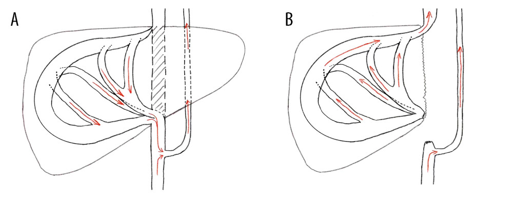 Characteristics of intrahepatic blood flow in the healthy side before and after operation(A) Before surgery, the outlet of RHV was also invaded and almost occluded, and the intrahepatic blood flowed back into the infrahepatic vena cava through the SHV after circling through the hepatic vein network in the right liver, and then flowed back to the right atrium through the vertebral venous plexus. (B) The SHV, RHV, and PV were well connected, so the SHV was sutured and closed. Postoperative blood flow was infrahepatic, and intrahepatic blood was flowed flowing directly into the right atrium through the paravertebral venous plexus. Intrahepatic blood was flowing out of the liver through the reconstructed RHV and flowing into the right atrium through the suprahepatic vena cava. Figures 4A and 4B were created using Adobe Photoshop 2022 V23.5.