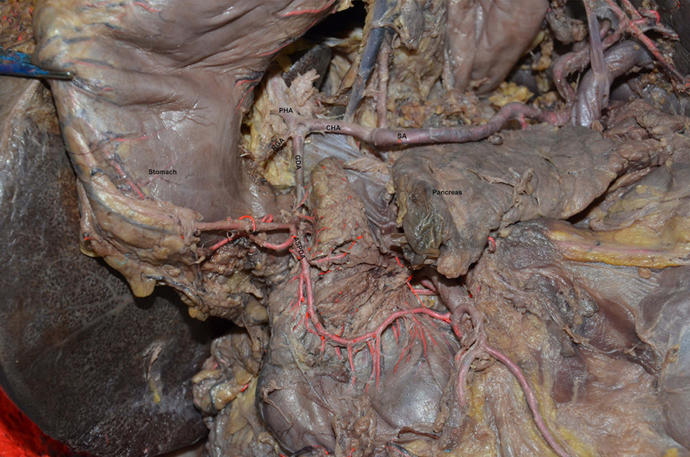 Anatomical diagram of extrahepatic duct blood supply (anterior view). PHA – proper hepatic artery; CHA – common hepatic artery; RGA – right gastric artery; SA – splenic artery.