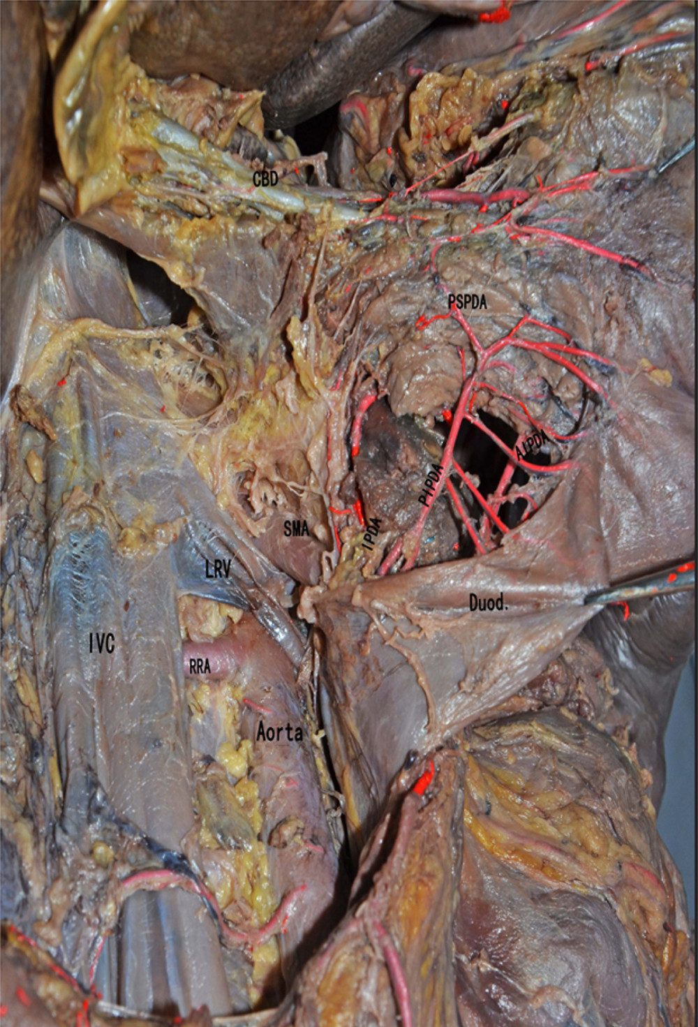 The anatomical diagram of extrahepatic duct blood supply (posterior view). The vascular network around the hilar bile originates mainly from the branches of the right hepatic artery and the gallbladder artery, and the bile vessel network below the common hepatic duct is more derived from the gastroduodenal artery and its branches including the posterior superior pancreaticoduodenal artery and the anterior superior pancreaticoduodenal artery. IVC – inferior vena cava; LRV – left renal vein; RRA – right renal artery.