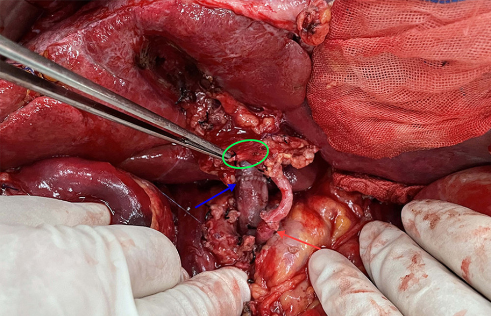 The picture of intraoperative hilar region before bile duct anastomosis. The vessel of the forceps lift was the donor-derived pancreaticoduodenal artery (green circle). The blue arrow indicates the portal vein anastomosis and the red arrow indicates the arterial anastomosis.