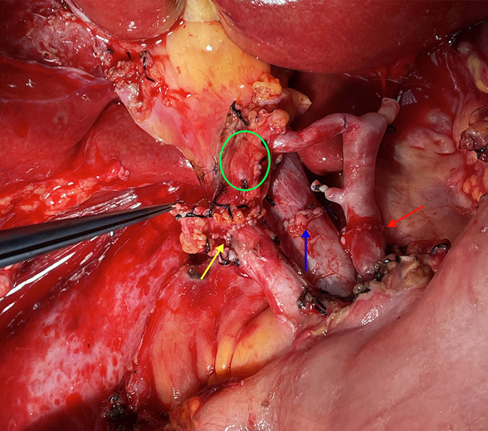 The picture of intraoperative hilar region after bile duct anastomosis. The green circle indicates donor-derived pancreaticoduodenal artery, and the yellow allow indicates the bile duct anastomosis. The blue arrow indicates the portal vein anastomosis and the red arrow indicates the arterial anastomosis.