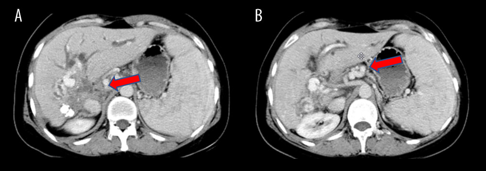 Preoperative CT scans of the patient(A) The lesion, situated in the hilar region, exhibits severe invasion into the portal vein, bile duct, and hepatic artery. (B) Portal vein occlusion has resulted in cavernous degeneration of the portal vein. The figure was created using Adobe Photoshop 2022 (Version: Photoshop 2022 V23.5; Manufacturer: Adobe).
