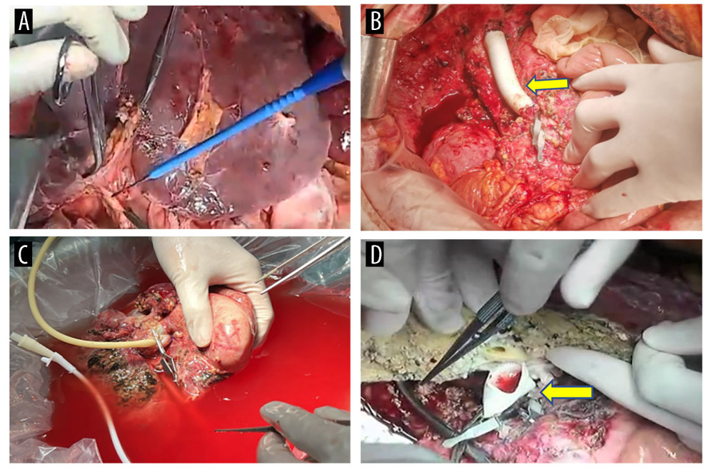 Surgical process(A) The liver prior to isolation. (B) A temporary venous diversion of the portal-hepatic vein was established post liver isolation. (C) The liver was perfused and revised in an ex vivo state. (D) The portal vein was reconstructed with artificial vessels. The arrow indicates the portal vein anastomosis. The figure was created using 3D Studio Max (Version: 3Dmax 2020; Manufacturer: Autodesk).