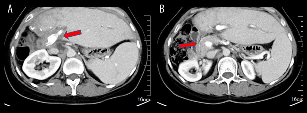 Ten-month postoperative CT scans show unobstructed portal vein flow(A) Intrahepatic portal vein flow is unobstructed. The arrow indicates an unobstructed artificial vessel flow. (B) The portal vein trunk is unobstructed with peripheral varicose vessels. The arrow indicates the portal vein trunk. The figure was created using Adobe Photoshop 2022 (Version: Photoshop 2022 V23.5; Manufacturer: Adobe).