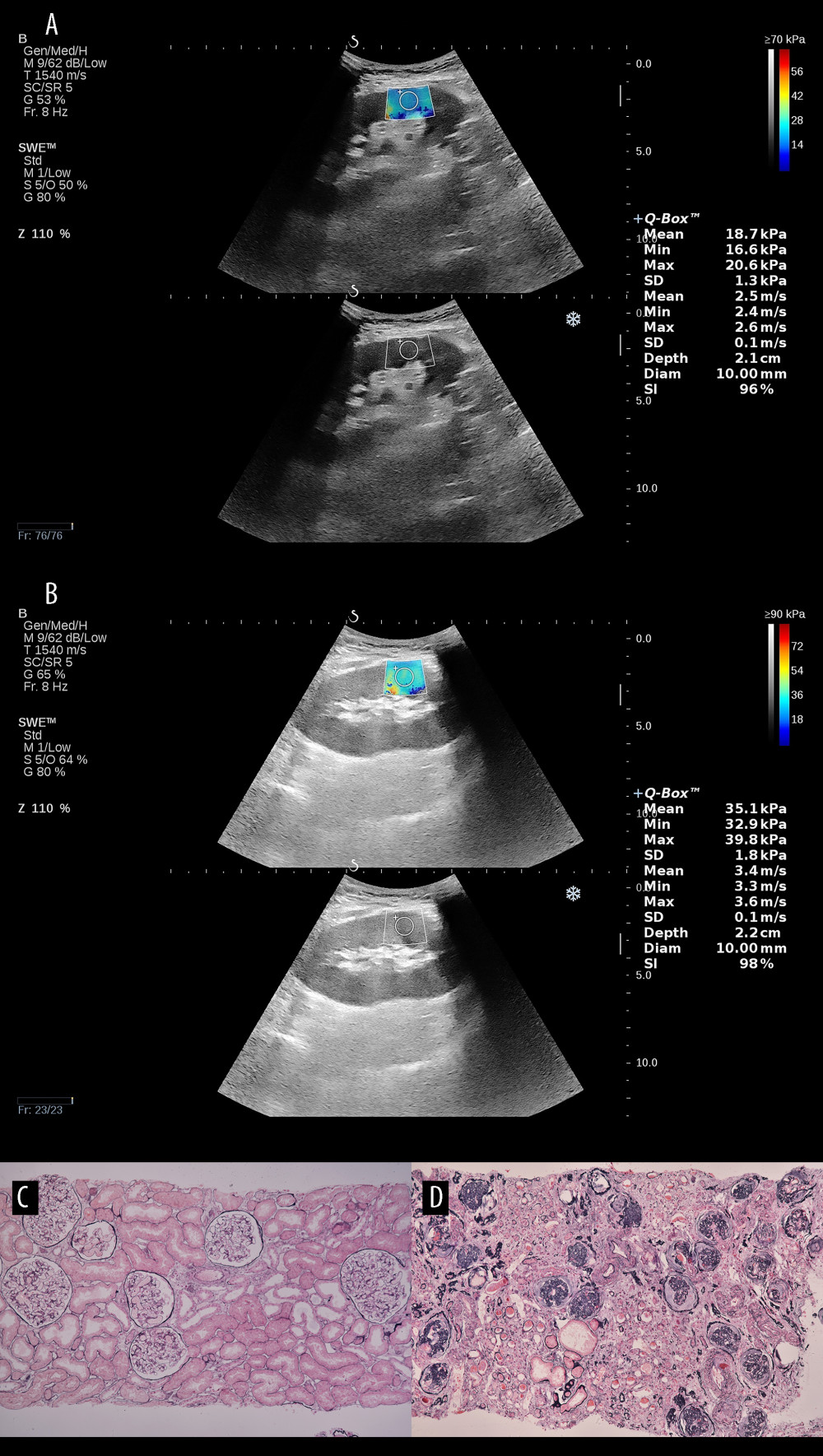 Comparison of ultrasound elastography and pathology findings between normal renal tissue and fibrotic renal tissue. (A) Shear wave elastography value of 18.7 kPa in normal renal tissue of the transplant kidney. (B) Shear wave elastography value of 35.1 kPa in severely fibrotic renal tissue of the transplant kidney. (C) Pathology result of normal renal tissue in the transplant kidney. (D) Pathology result of severely fibrotic renal tissue in the transplant kidney (Adobe Photoshop, 2022, Adobe, Inc.).