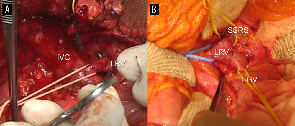 Intraoperative photographs showing vascular isolation. (A) The proximal left renal vein (LRV) was isolated from the inferior vena cava (IVC) after Kocher maneuver. The LRV was ligated at the vessel-loop encircled site with a synthetic umbilical tape. (B) The proximal LRV was isolated with individual encircling of the spontaneous splenorenal shunt (SSRS) and left gonadal vein (LGV).